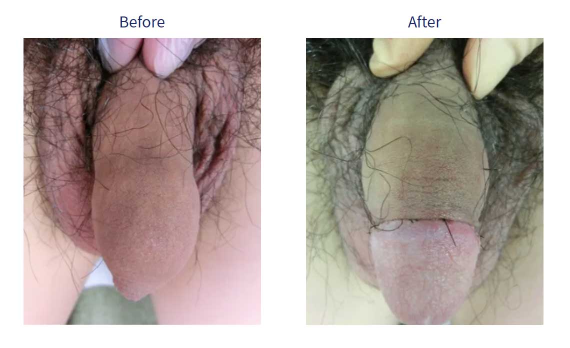 症例1-1包茎手術